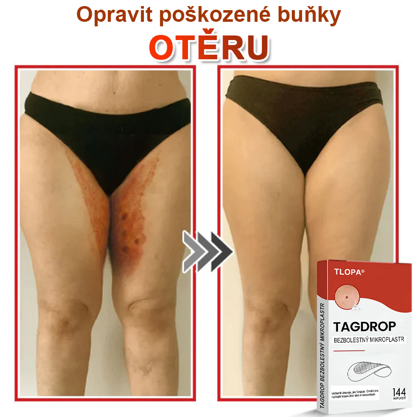 TLOPA® Mikrovpichová botanická náplast na odstranění kožních výrůstků 🇨🇿 Vyrobeno v Česká republika