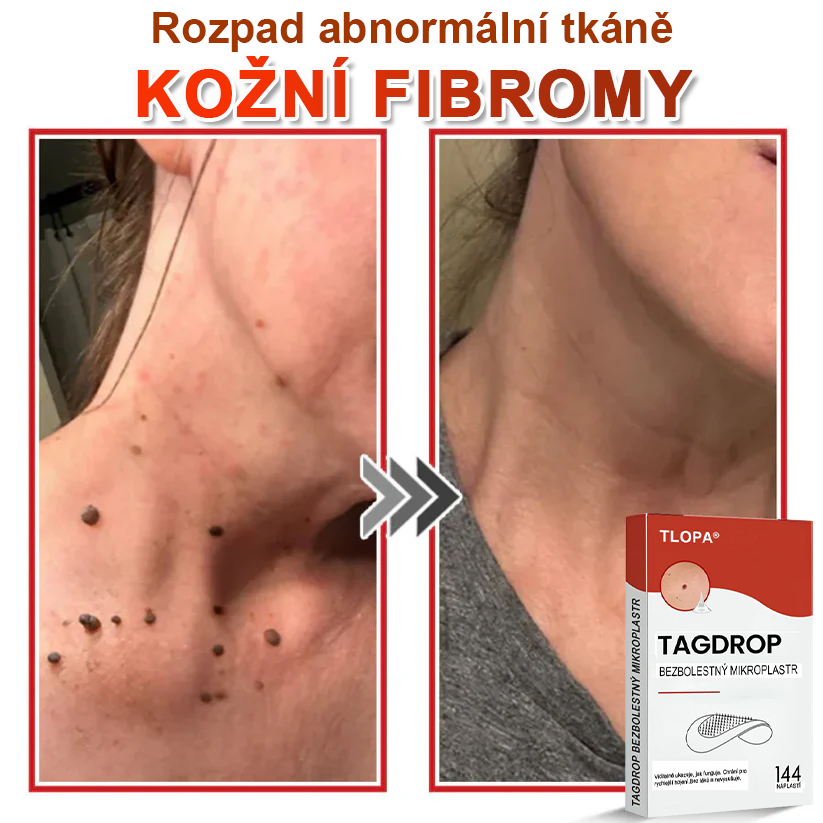 TLOPA® Mikrovpichová botanická náplast na odstranění kožních výrůstků 🇨🇿 Vyrobeno v Česká republika