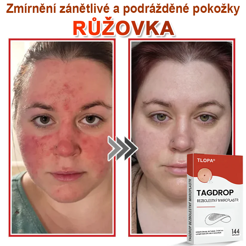TLOPA® Mikrovpichová botanická náplast na odstranění kožních výrůstků 🇨🇿 Vyrobeno v Česká republika