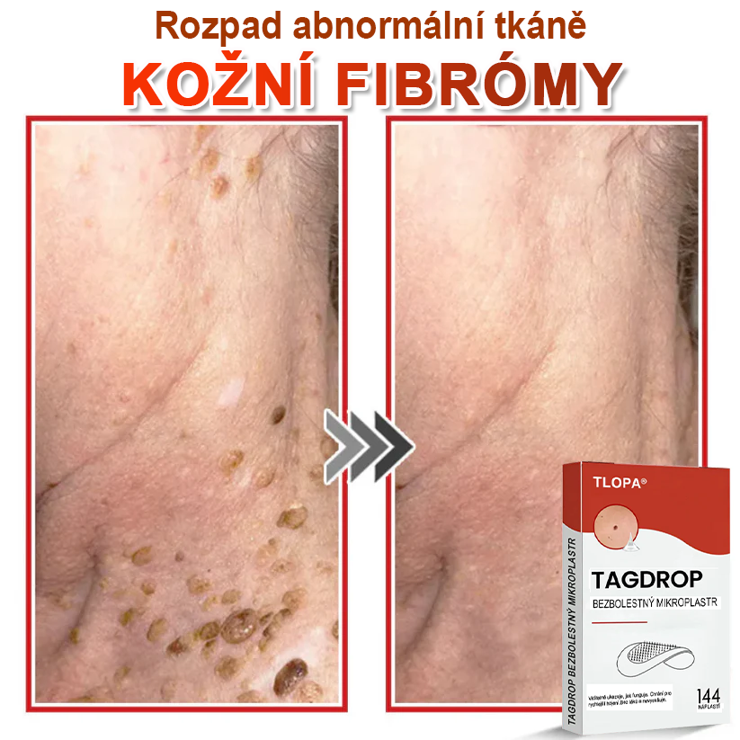 TLOPA® Mikrovpichová botanická náplast na odstranění kožních výrůstků 🇨🇿 Vyrobeno v Česká republika