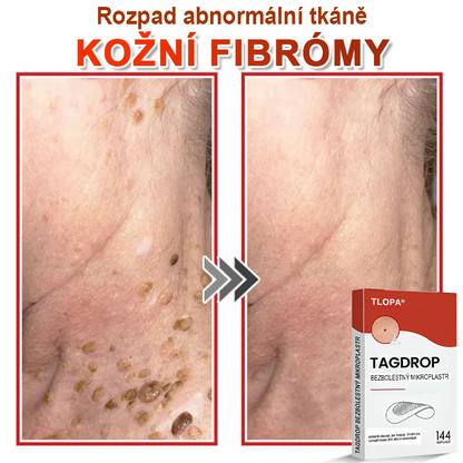 TLOPA® Mikrovpichová botanická náplast na odstranění kožních výrůstků 🇨🇿 Vyrobeno v Česká republika