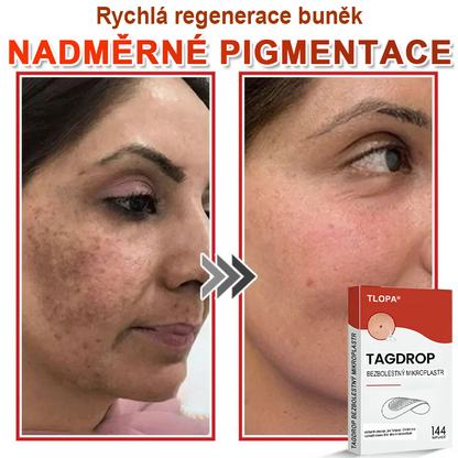 TLOPA® Mikrovpichová botanická náplast na odstranění kožních výrůstků 🇨🇿 Vyrobeno v Česká republika