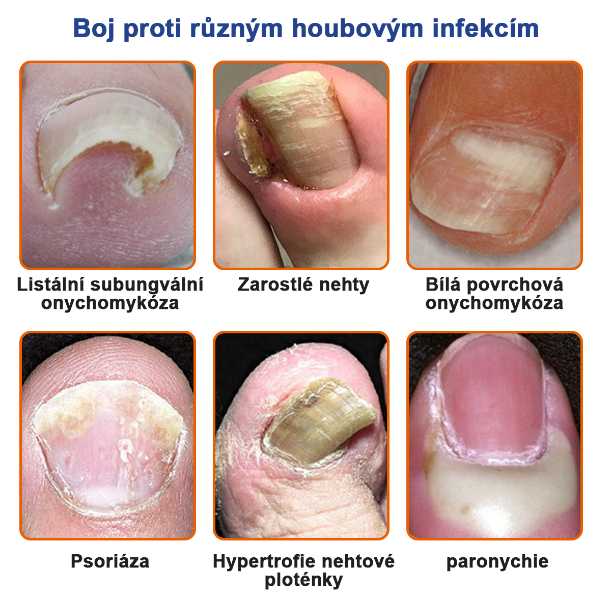 🐝🐝Furzero™ Včelí jed na plíseň nehtů: kompletní řešení plísně nehtů 🌟👣