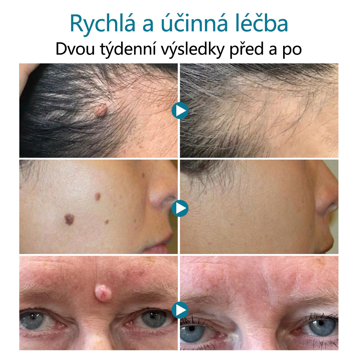 Laserové pero pro odstraňování znamének a bradavic DAFEILA® LumeSkin