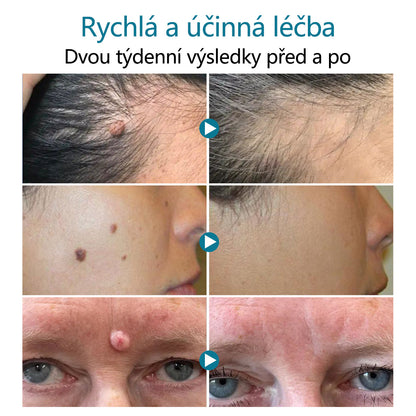 Laserové pero pro odstraňování znamének a bradavic DAFEILA® LumeSkin