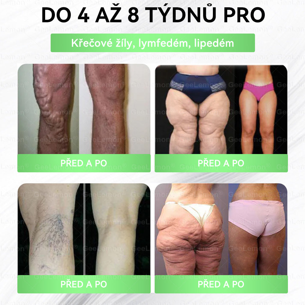 🔥Doporučeno Fakultní nemocnicí Motol · 👩‍⚕️ Oficiální prodejna BENU | 🎁 𝐆𝐞𝑒𝑙𝑒𝐦𝐨𝐧® Glum𝐚𝐬𝐞tide 8 v 1 – Zeštíhlující nano mikrojihlový náplast 🇨🇿 Jen 1× denně ✅ Viditelné změny za 7 dní – na obezitu, kardiovaskulární zdraví, diabetes a kloubní problémy🎁🎁🎁🎁