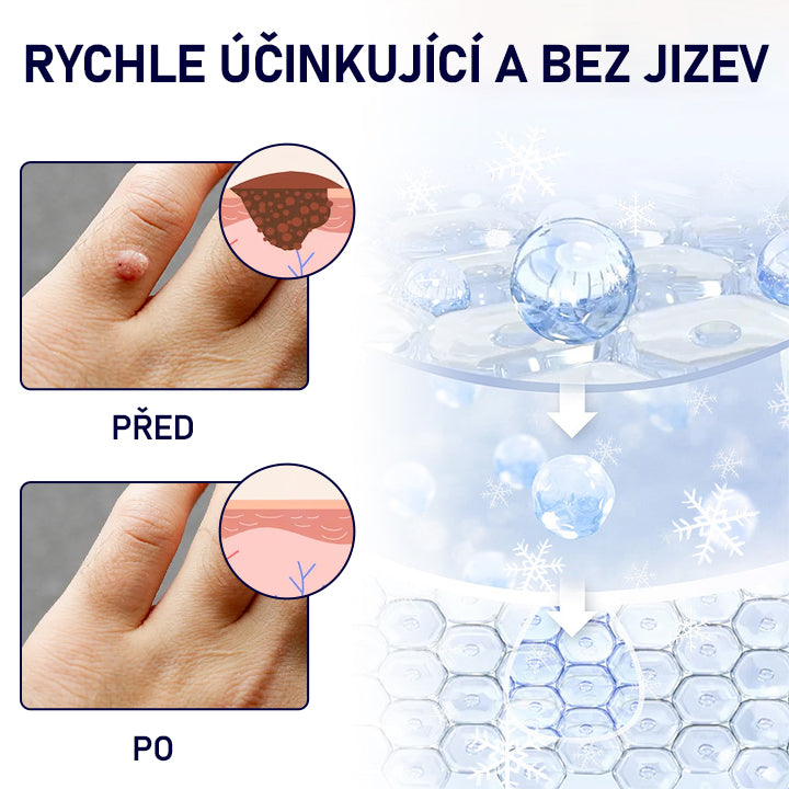Lékárna Na Poště | Timilk® WartErase Kryogenní sprej🔥🔥