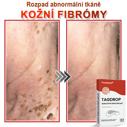 Pureluxo® Mikrovpichová botanická náplast na odstranění kožních výrůstků 🇨🇿 Vyrobeno v Česká republika🇨🇿🇨🇿🇨🇿🇨🇿