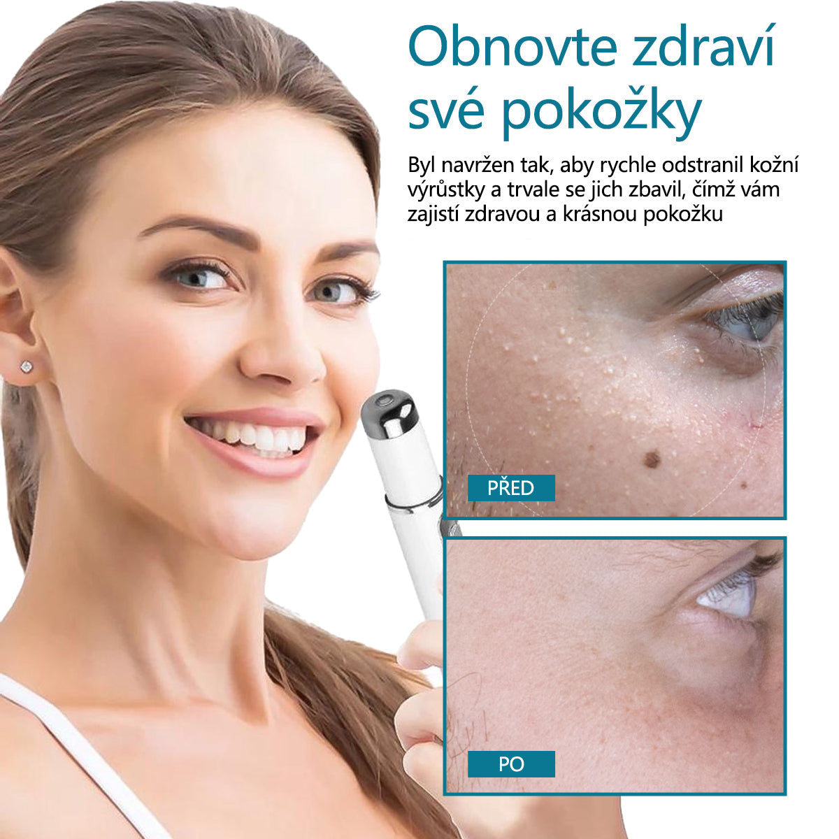 Laserové pero pro odstraňování znamének a bradavic DAFEILA® LumeSkin