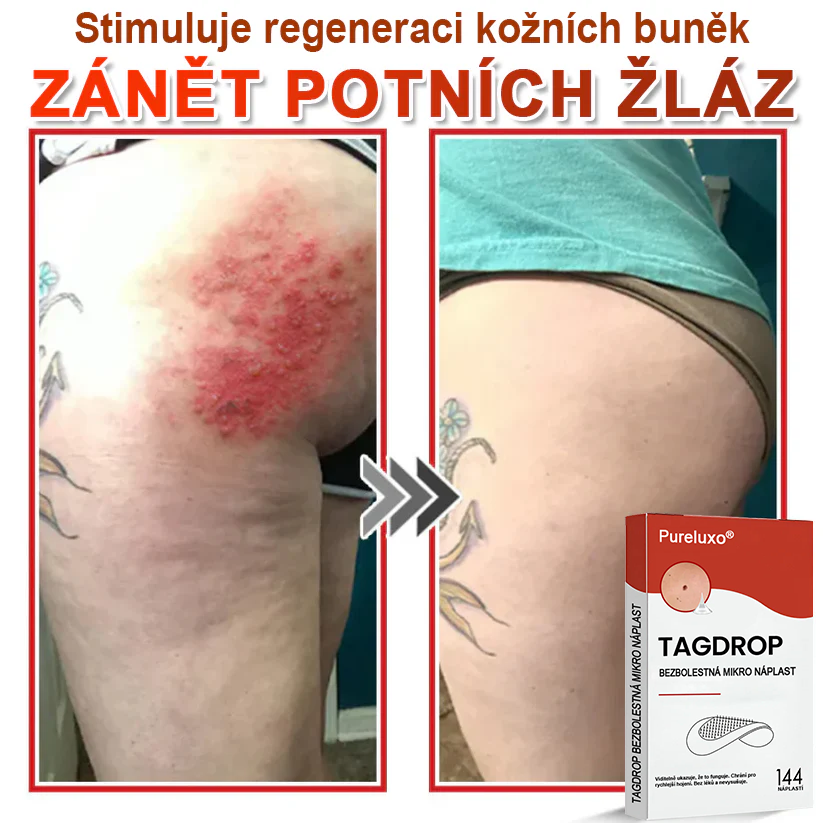 Pureluxo® Mikrovpichová botanická náplast na odstranění kožních výrůstků 🇨🇿 Vyrobeno v Česká republika🇨🇿🇨🇿🇨🇿🇨🇿